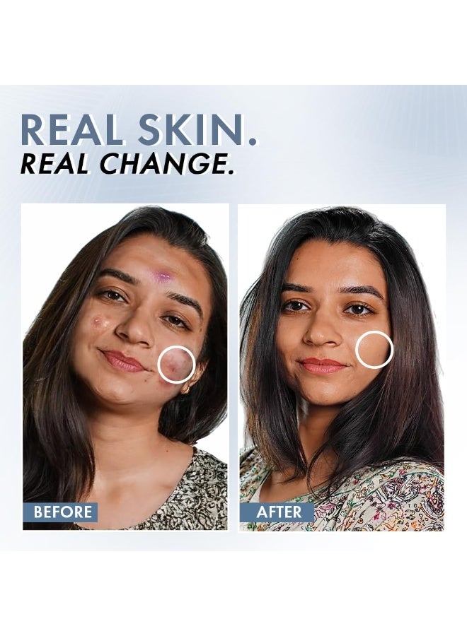 ThriveCo 2% Salicylic Acid Face Serum | Helps Reduce Acne & Blackheads | Controls Oil & Unclogs Pores | Exfoliating Serum for Oily & Acne-Prone Skin | 30 ml - Image 2